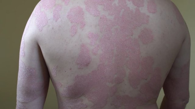  examined by a doctor. psoriasis