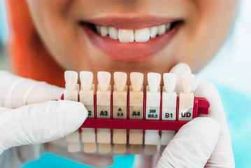 Prosthetic dentistry. Matching colour of the tooth enamel with whitening chart. Dentistry...