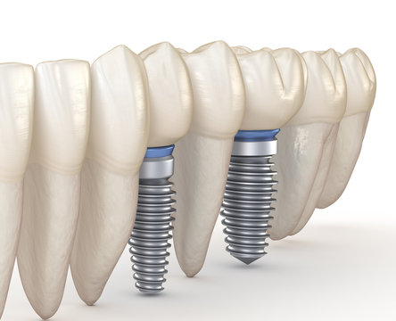 Dental Implants in line. 3D illustration concept of human teeth.