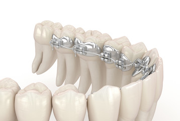 Lingual braces system. 3D illustration concept of silver braces - obrazy, fototapety, plakaty