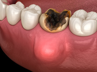 Periodontitis and gum inflammation. Medically accurate dental 3D illustration