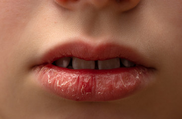 Close up of rough chapped lips