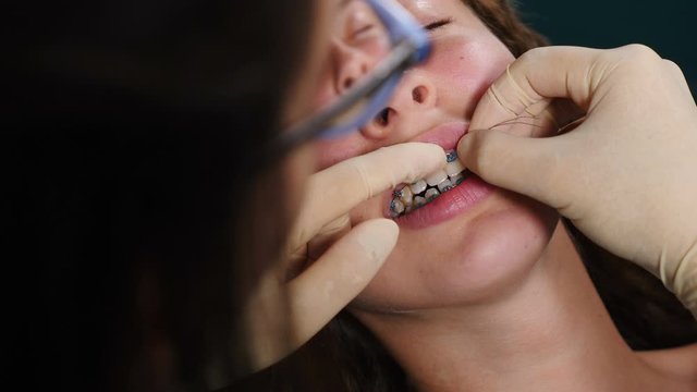 Process of dentist Instaling Braces on Patient, Close-Up. Orthodontic Treatment. Teeth with dental braces. Bite correction. Orthodontist at work. Attractive young woman visiting orthodontist in modern