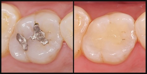銀歯　セラミック　歯科治療