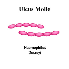 Ulcus Molle, Haemophilus ducreyi. Bacterial infections. Sexually transmitted diseases. Infographics. Vector illustration on isolated background.