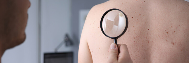 Male doctor look at magnifying glass on patient skin against hospital office background. Lesions...