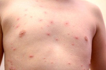 Fototapeta premium Child skin infected with chickenpox