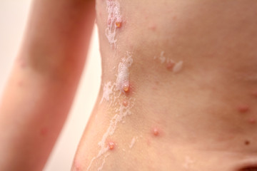 Therapy against the virus of Varicella has measles, chicken pox, rubella