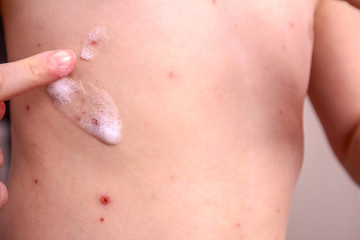 Therapy against the virus of Varicella has measles, chicken pox, rubella