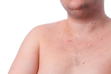 Fat man with acne irritations on the body on a white background isolate. close up copy space