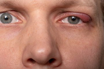 Close the upper left eyelid abscess. Eye with barley.