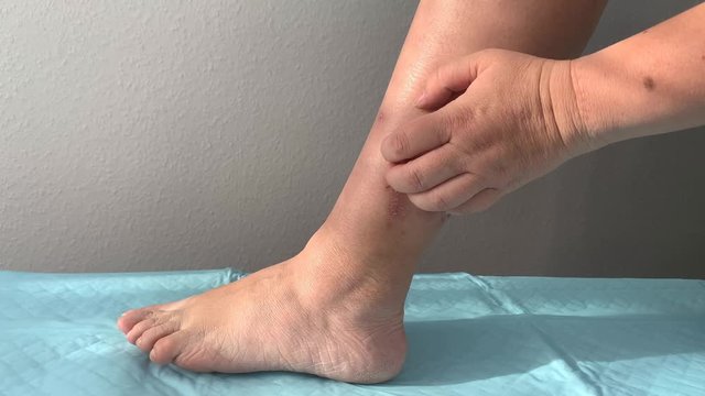 woman scratches an itchy wound on her leg, wound treatment. 4k, slow-motion shooting