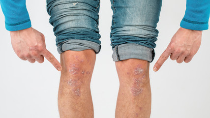 Close-up of the legs of a man suffering from chronic psoriasis on a white background.