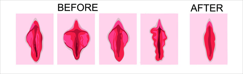 before and after surgery on a pink background