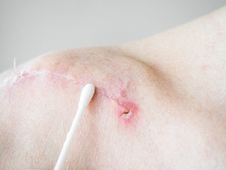 scar after surgery on the clavicle on the male body. treatment of scar on the clavicle after...