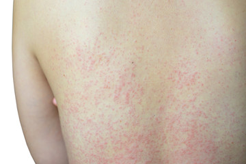 Close up Allergy rash isolated on white background. Around Back view of asian women with dermatitis problem of rash ,Allergy rash and Health problem.