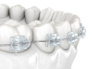 Teeth and Clear braces. Medically accurate dental 3D illustration