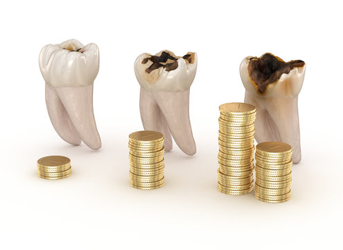 Dental restoration graph. 3D illustration concept