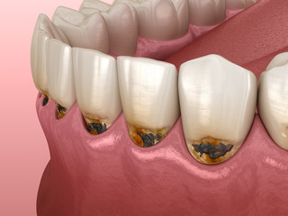 Cervical caries on frontal teeth. Medically accurate tooth 3D illustration.