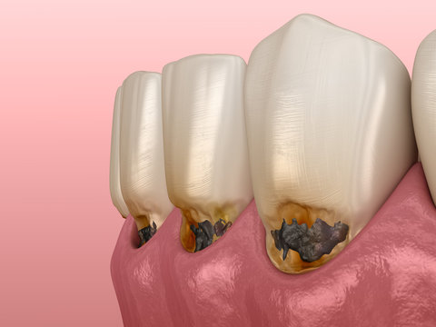 Cervical caries on frontal teeth. Medically accurate tooth 3D illustration.