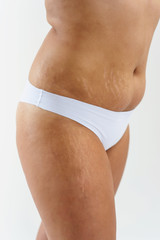 Fototapeta na wymiar Woman showing her cellulite and stretch marks. Problems of obesity, women body, fat burning