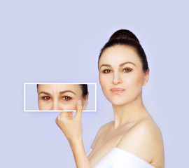 Lower and upper Blepharoplasty.	