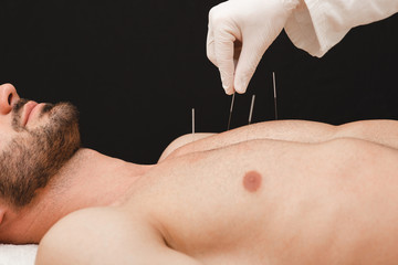 Acupuncture needles in reflexologist hand close up on black background. Treating diseases using...