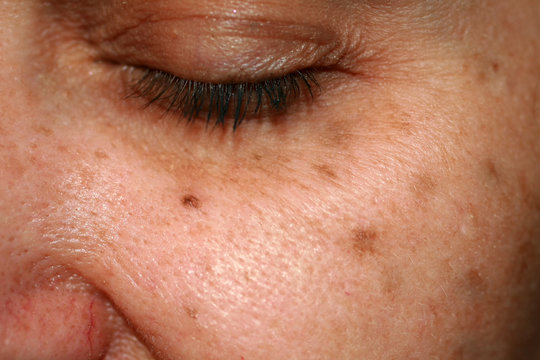 Brown spots on the face. Pigmentation on the skin. Brown age spots on the cheek.