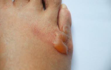 Scald foot pain dangerous from heat water after acident waiting doctor take care at the hospital