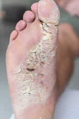 Hautkrankheit, Atiopischer Winterfuß, Fußekzem, Hautekzem, Dermatitis plantaris sicca,...