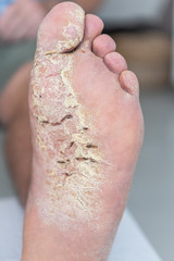 Hautkrankheit, Atiopischer Winterfuß, Fußekzem, Hautekzem, Dermatitis plantaris sicca, Ekzemkrankheiten, Atopisches Ekzem, Hautausschlag