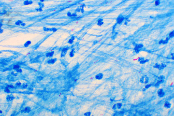 Mycobacterium tuberculosis positive (small red rod) in sputum smear, acid-fast stain, analyze by...