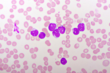Picture of acute lymphocytic leukemia or ALL cells in blood smear, analyze by microscope, 1000x