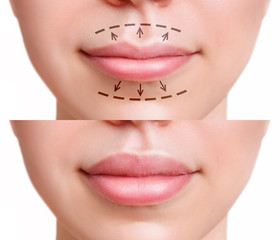 Sensual female lips before anf after augmentation procedure.