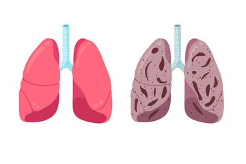 Healthy and unhealthy lungs compare concept. Human respiratory system internal organ strong and pneumonia inflammation. Healthcare respiration medical anatomy vector illustration
