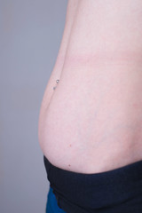 one of the stages of postpartum excess growth of adipose tissue and skin of the abdomen, after...
