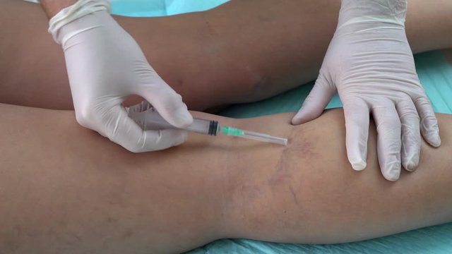 doctor's hands open a syringe before injection. sclerotherapy.