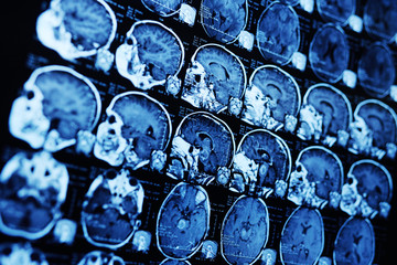 MRI (magnetic resonance image) scan of a patient with a tumor in the brain stem. Neurosurgery,...