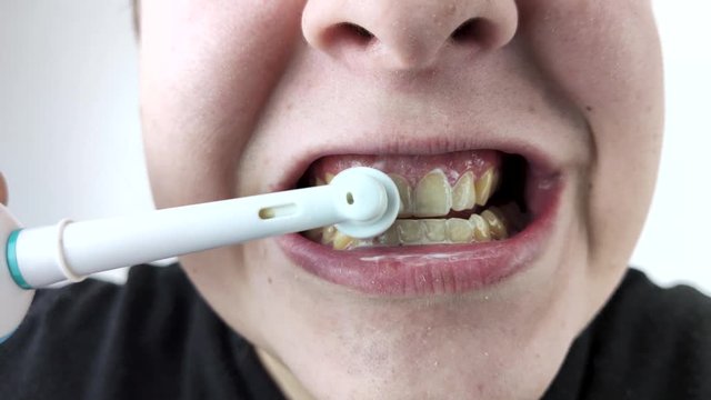 Gums bleeding and inflammation close up. Man man brushes his teeth with an electric brush and his gums are bleeding.