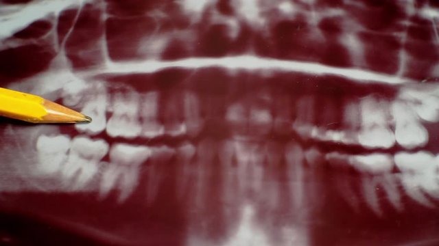panoramic x-ray picture of the jaw of an adult men.close-up