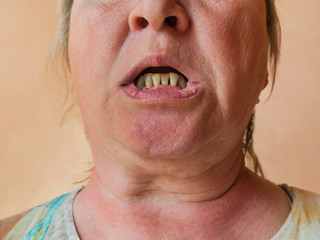 Periodontitis, an inflammatory process in the gums. Exposure of the necks of the teeth. The doctor...