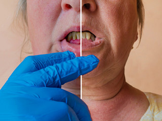 Periodontitis, an inflammatory process in the gums. Exposure of the necks of the teeth. The doctor...