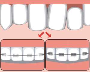 Crooked teeth on the upper jaw as a concept for bite treatment, vector stock illustration with molars with ceramic or metal braces before and after the orthodontist or dentist © Vikkymir Store