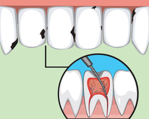 Teeth on the upper jaw with caries as a concept for the treatment of pulpitis and cleansing the canal, flat vector stock illustration with molars and incisors and the services of an orthodontic