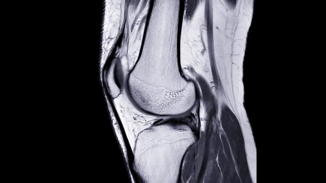MRI knee or Magnetic resonance imaging of knee joint comparison sagittal PDW view.