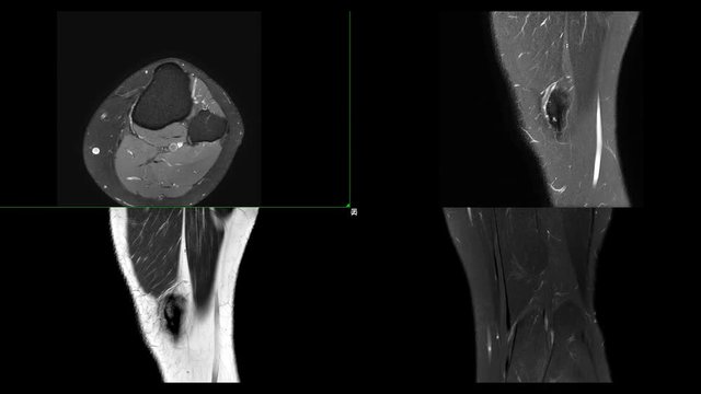 Compare of MRI knee or Magnetic resonance imaging of knee joint  stir technique of axial, sagittal and coronal view with sag t2 for fat suppression.