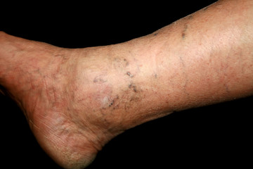 Leg. Varicose veins. Phlebeurysm. Thrombophlebitis. leg in veins.