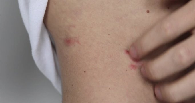 Man Scratch The Itch With Hand, Red Spots On The Waist