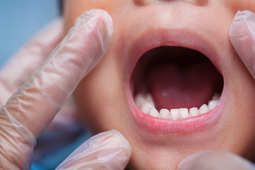 A close-up of a toddlers dental visit, showing the dentist holding the kids mouth open during checkup.