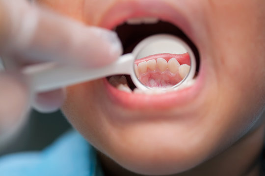 A close-up of a young boy getting a dental exam by dentist and using dental mirror to see baby teeth and gums.